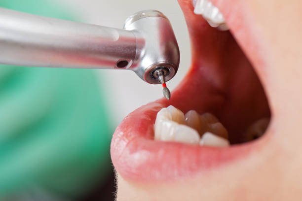 Best Emergency Tooth Extraction in Columbia Falls, MT